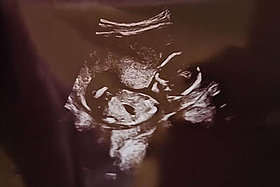 Ultraschallbild, auf dem ein Foetus in der 16. Schwangerschaftswoche zu sehen ist. Kerstin hat Mukoviszidose und ist plötzlich und ungeplant schwanger geworden. 