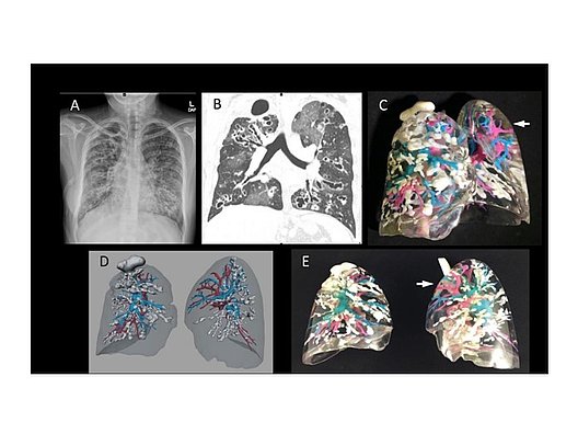 Abbildung 1: Vom Bild zum Patienten-individuellen 3D-Model bei CF.