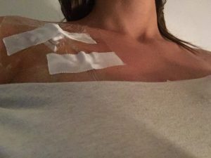 Bereits fünf Tage nach der OP wurde mein Port angestochen, und ich startete eine i.v.-Therapie