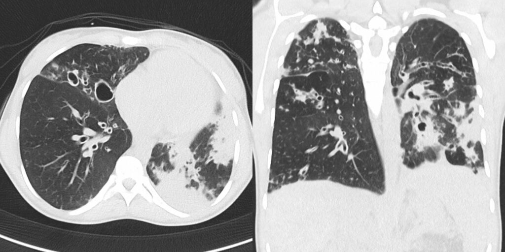 CT der Lunge einer Mukoviszidose-Patientin