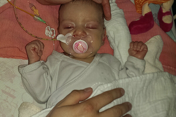 Baby mit Schnuller und Schlauch in der Nase im Krankenhaus. Annalenas Start ins Leben war schwierig, sie hatte direkt nach der Geburt einen Darmverschluss. Eine häufige Komplikation bei Mukoviszidose. 