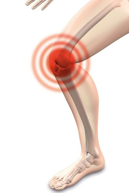Symbolbild Arthropathien. Foto: Pixabay, naturwohl-gesundheit. 
